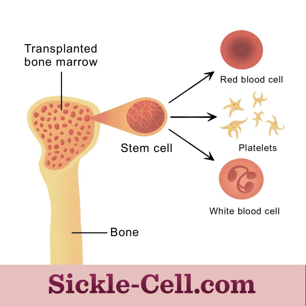 Image - Sickle-Cell.com