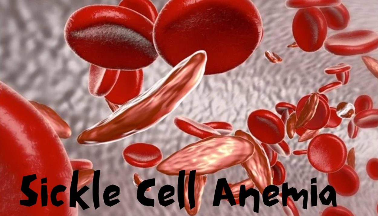 Sickle Cell Anemia