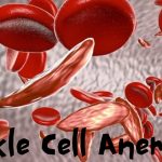 Sickle Cell Anemia