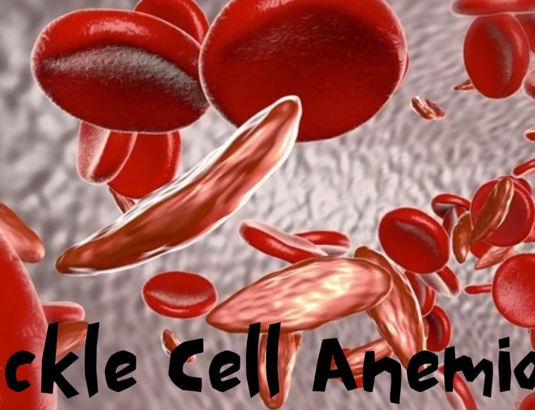 Sickle Cell Anemia