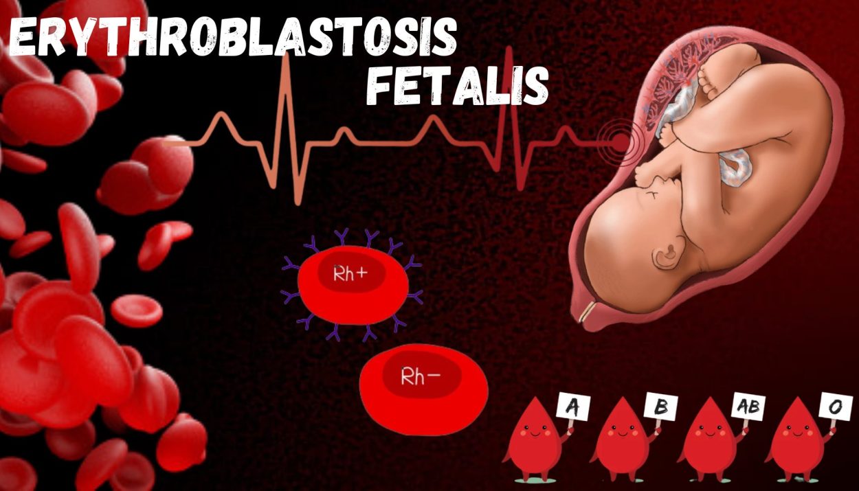 Erythroblastosis Fetalis