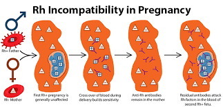 Pic- Birth Injury